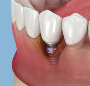 Periimplantitis: la enfermedad que puede poner en riesgo tus implantes